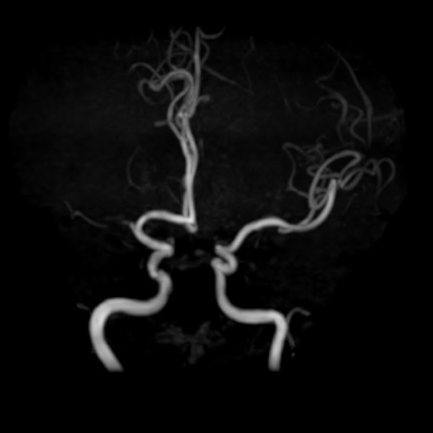 动脉长鞘怎么置入一技之“长”丨经桡及经股困难入路应用赛诺神畅APEX TRA GC™导引导管建立通路病例合集_https://www.jmylbn.com_新闻资讯_第29张