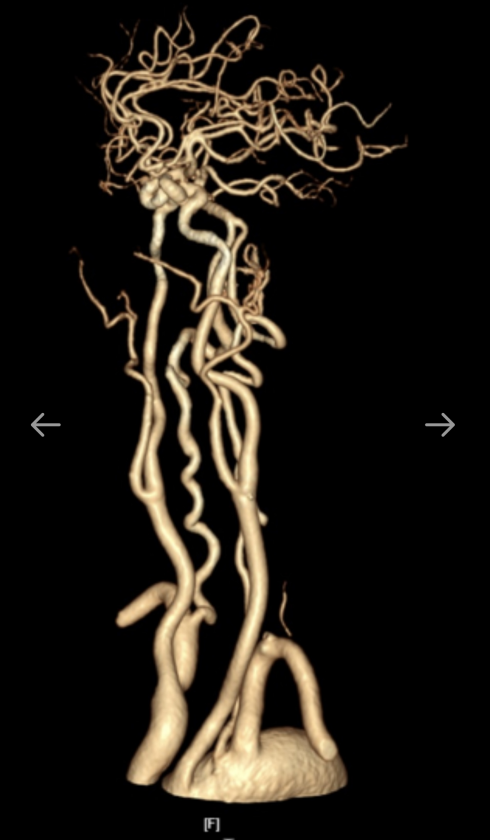 动脉长鞘怎么置入一技之“长”丨经桡及经股困难入路应用赛诺神畅APEX TRA GC™导引导管建立通路病例合集_https://www.jmylbn.com_新闻资讯_第6张