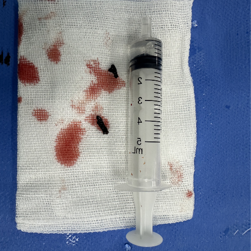 动脉长鞘怎么置入一技之“长”丨经桡及经股困难入路应用赛诺神畅APEX TRA GC™导引导管建立通路病例合集_https://www.jmylbn.com_新闻资讯_第14张