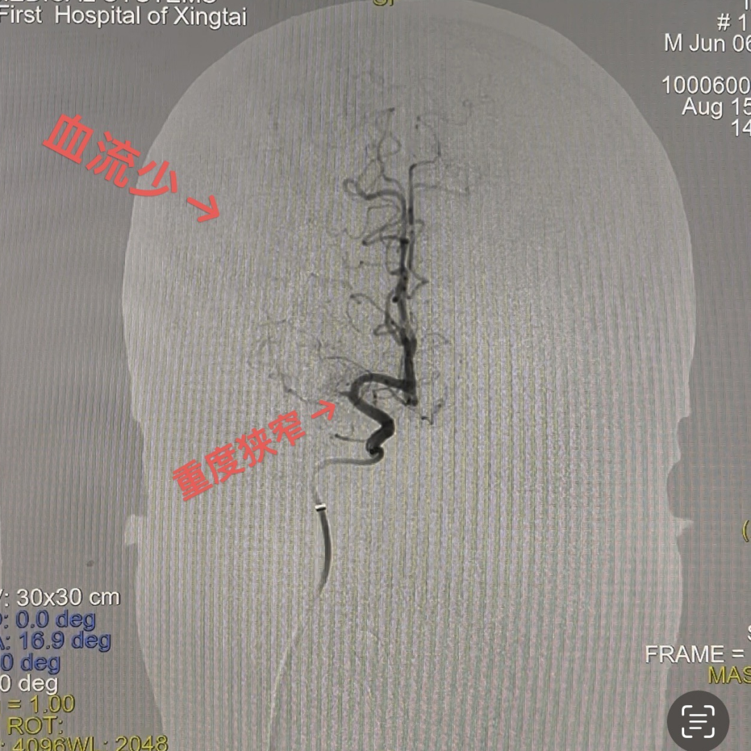 动脉长鞘怎么置入一技之“长”丨经桡及经股困难入路应用赛诺神畅APEX TRA GC™导引导管建立通路病例合集_https://www.jmylbn.com_新闻资讯_第31张