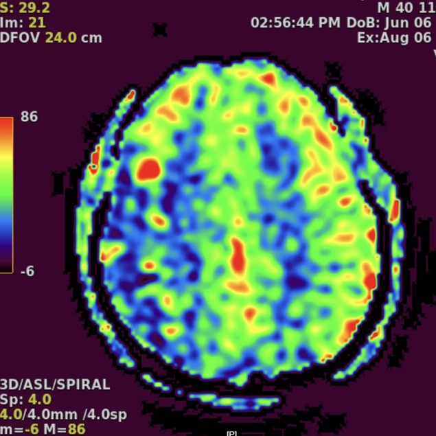 动脉长鞘怎么置入一技之“长”丨经桡及经股困难入路应用赛诺神畅APEX TRA GC™导引导管建立通路病例合集_https://www.jmylbn.com_新闻资讯_第30张