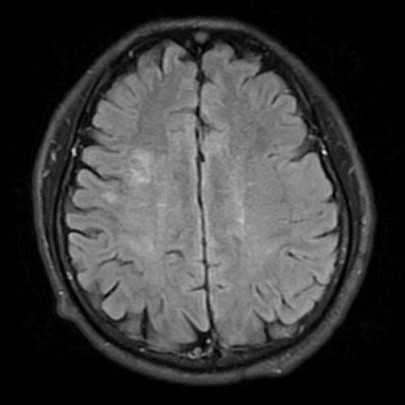 动脉长鞘怎么置入一技之“长”丨经桡及经股困难入路应用赛诺神畅APEX TRA GC™导引导管建立通路病例合集_https://www.jmylbn.com_新闻资讯_第28张