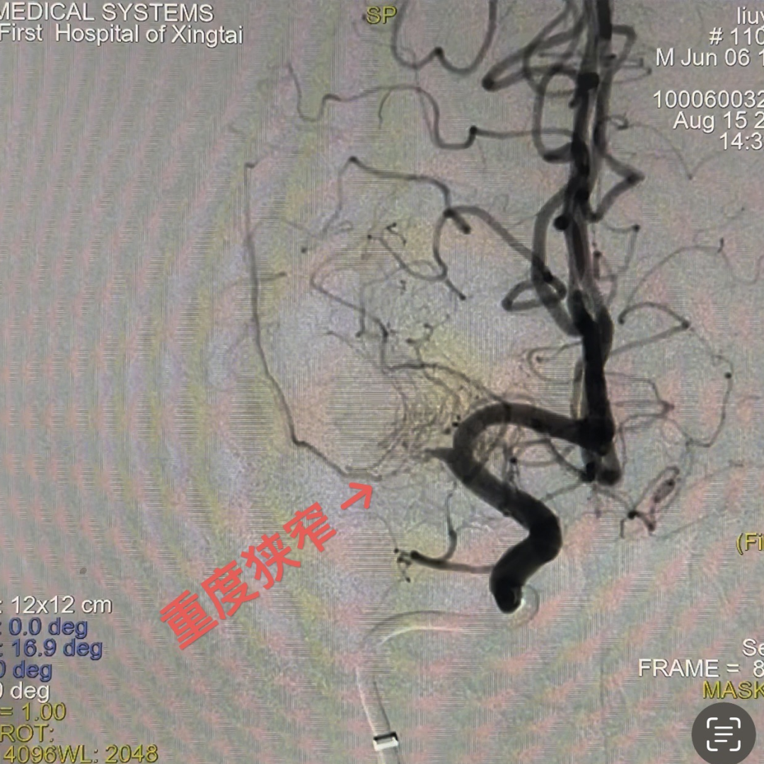 动脉长鞘怎么置入一技之“长”丨经桡及经股困难入路应用赛诺神畅APEX TRA GC™导引导管建立通路病例合集_https://www.jmylbn.com_新闻资讯_第32张