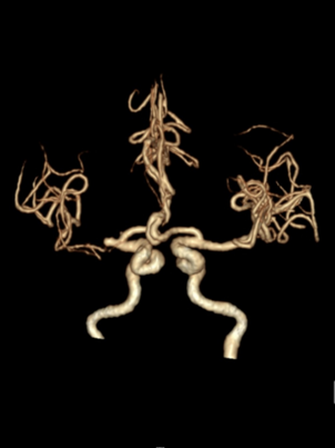 动脉长鞘怎么置入一技之“长”丨经桡及经股困难入路应用赛诺神畅APEX TRA GC™导引导管建立通路病例合集_https://www.jmylbn.com_新闻资讯_第5张