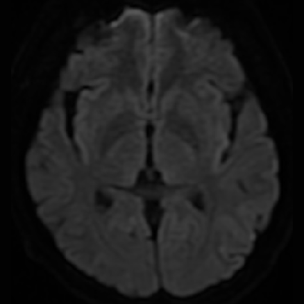 动脉长鞘怎么置入一技之“长”丨经桡及经股困难入路应用赛诺神畅APEX TRA GC™导引导管建立通路病例合集_https://www.jmylbn.com_新闻资讯_第27张
