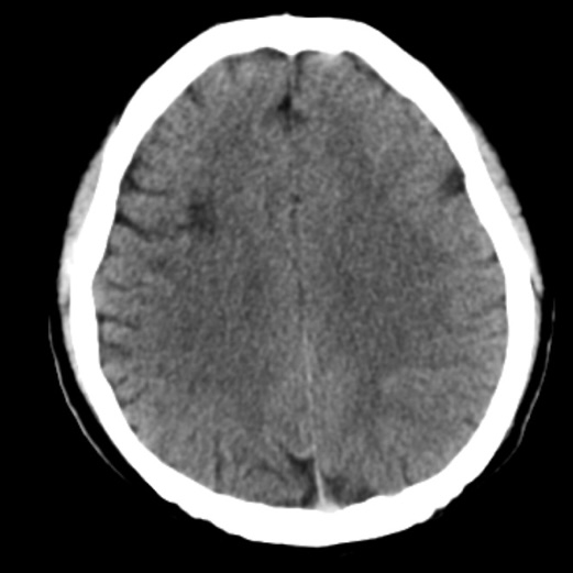 动脉长鞘怎么置入一技之“长”丨经桡及经股困难入路应用赛诺神畅APEX TRA GC™导引导管建立通路病例合集_https://www.jmylbn.com_新闻资讯_第26张