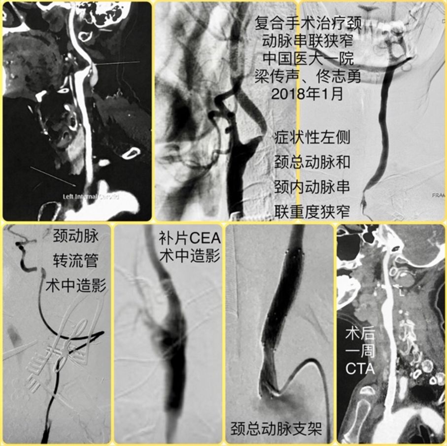 病例分享丨复合手术治疗左侧颈总动脉和颈内动脉串联重度狭窄一例