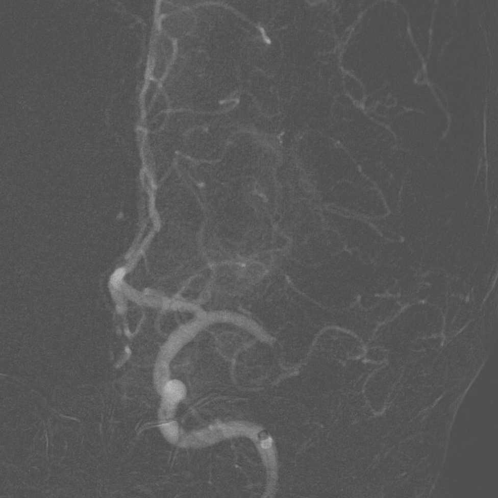 动脉长鞘怎么置入【沙场点兵 有史可鉴】Trevo ProVue联合Infinity长鞘经桡动脉取栓分享_https://www.jmylbn.com_新闻资讯_第14张