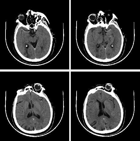 动脉长鞘怎么置入【沙场点兵 有史可鉴】Trevo ProVue联合Infinity长鞘经桡动脉取栓分享_https://www.jmylbn.com_新闻资讯_第22张