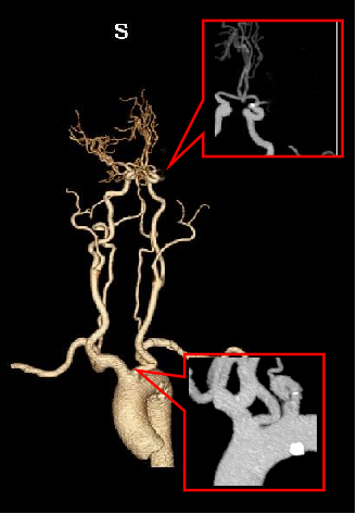 动脉长鞘怎么置入【沙场点兵 有史可鉴】Trevo ProVue联合Infinity长鞘经桡动脉取栓分享_https://www.jmylbn.com_新闻资讯_第6张