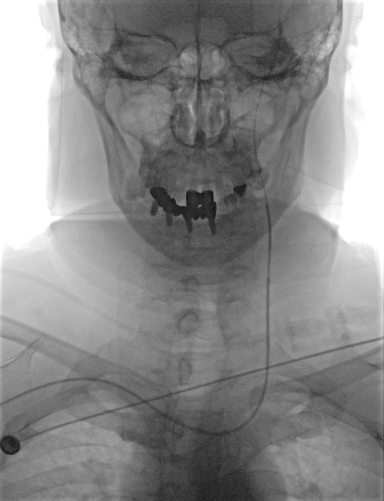 动脉长鞘怎么置入【沙场点兵 有史可鉴】Trevo ProVue联合Infinity长鞘经桡动脉取栓分享_https://www.jmylbn.com_新闻资讯_第11张