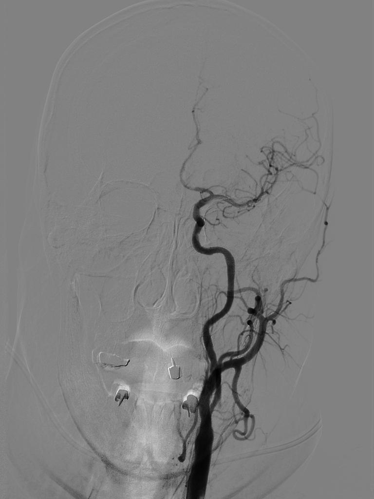 动脉长鞘怎么置入【沙场点兵 有史可鉴】Trevo ProVue联合Infinity长鞘经桡动脉取栓分享_https://www.jmylbn.com_新闻资讯_第20张