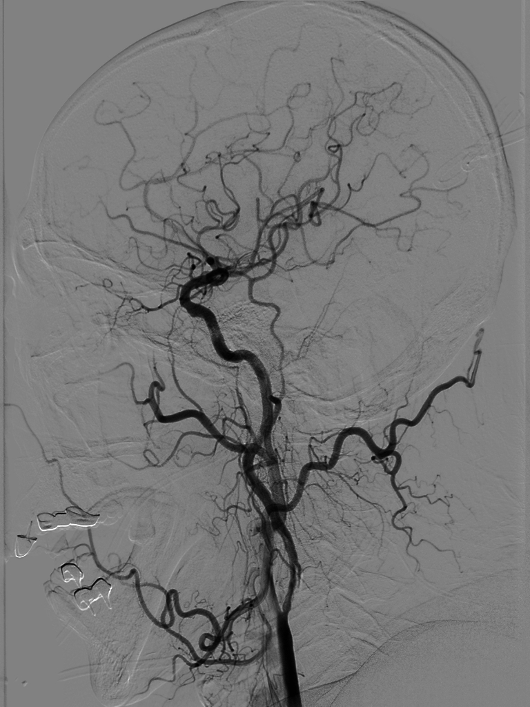 动脉长鞘怎么置入【沙场点兵 有史可鉴】Trevo ProVue联合Infinity长鞘经桡动脉取栓分享_https://www.jmylbn.com_新闻资讯_第21张