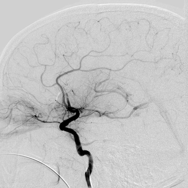 动脉长鞘怎么置入【沙场点兵 有史可鉴】Trevo ProVue联合Infinity长鞘经桡动脉取栓分享_https://www.jmylbn.com_新闻资讯_第13张