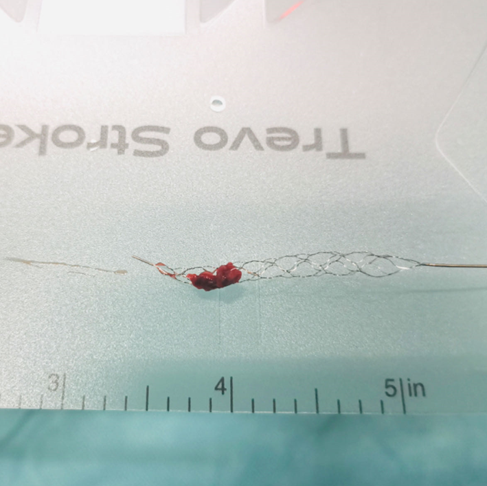 动脉长鞘怎么置入【沙场点兵 有史可鉴】Trevo ProVue联合Infinity长鞘经桡动脉取栓分享_https://www.jmylbn.com_新闻资讯_第17张