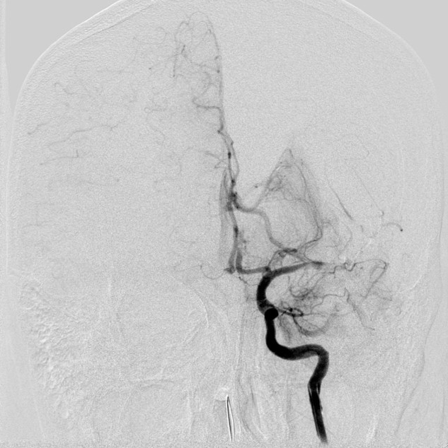 动脉长鞘怎么置入【沙场点兵 有史可鉴】Trevo ProVue联合Infinity长鞘经桡动脉取栓分享_https://www.jmylbn.com_新闻资讯_第12张