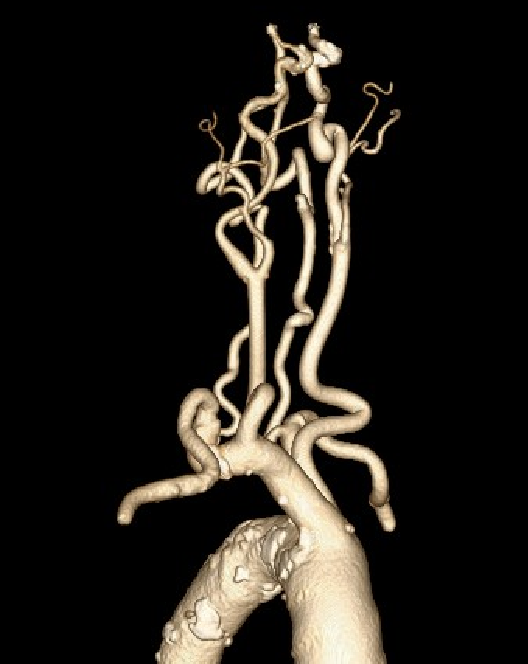 什么叫桡鞘【例久弥新】寻道于桡——瑞康通5.5F IntroSky X导管鞘经桡动脉行右侧大脑中动脉取栓一例_https://www.jmylbn.com_新闻资讯_第10张