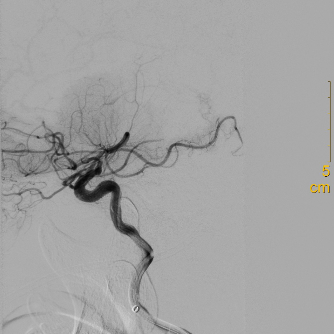 什么叫桡鞘【例久弥新】寻道于桡——瑞康通5.5F IntroSky X导管鞘经桡动脉行右侧大脑中动脉取栓一例_https://www.jmylbn.com_新闻资讯_第19张