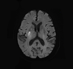 什么叫桡鞘【例久弥新】寻道于桡——瑞康通5.5F IntroSky X导管鞘经桡动脉行右侧大脑中动脉取栓一例_https://www.jmylbn.com_新闻资讯_第31张