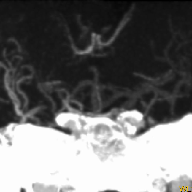 什么叫桡鞘【例久弥新】寻道于桡——瑞康通5.5F IntroSky X导管鞘经桡动脉行右侧大脑中动脉取栓一例_https://www.jmylbn.com_新闻资讯_第7张