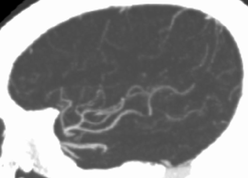 什么叫桡鞘【例久弥新】寻道于桡——瑞康通5.5F IntroSky X导管鞘经桡动脉行右侧大脑中动脉取栓一例_https://www.jmylbn.com_新闻资讯_第8张