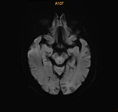 什么叫桡鞘【例久弥新】寻道于桡——瑞康通5.5F IntroSky X导管鞘经桡动脉行右侧大脑中动脉取栓一例_https://www.jmylbn.com_新闻资讯_第28张