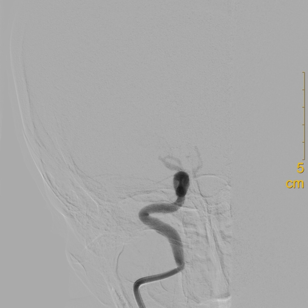什么叫桡鞘【例久弥新】寻道于桡——瑞康通5.5F IntroSky X导管鞘经桡动脉行右侧大脑中动脉取栓一例_https://www.jmylbn.com_新闻资讯_第14张