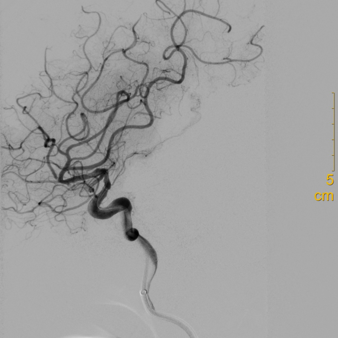 什么叫桡鞘【例久弥新】寻道于桡——瑞康通5.5F IntroSky X导管鞘经桡动脉行右侧大脑中动脉取栓一例_https://www.jmylbn.com_新闻资讯_第23张