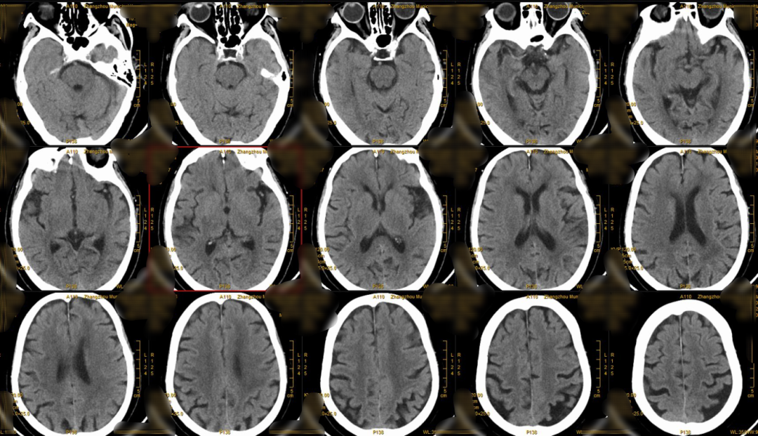 什么叫桡鞘【例久弥新】寻道于桡——瑞康通5.5F IntroSky X导管鞘经桡动脉行右侧大脑中动脉取栓一例_https://www.jmylbn.com_新闻资讯_第3张