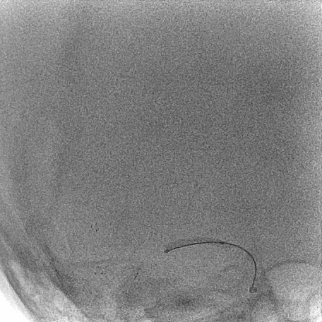 什么叫桡鞘【例久弥新】寻道于桡——瑞康通5.5F IntroSky X导管鞘经桡动脉行右侧大脑中动脉取栓一例_https://www.jmylbn.com_新闻资讯_第21张