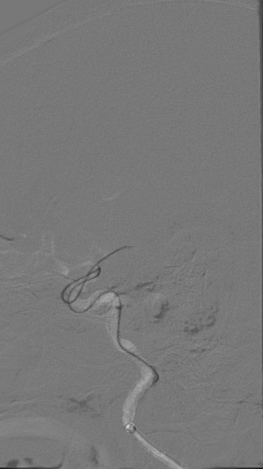 什么叫桡鞘【例久弥新】寻道于桡——瑞康通5.5F IntroSky X导管鞘经桡动脉行右侧大脑中动脉取栓一例_https://www.jmylbn.com_新闻资讯_第17张
