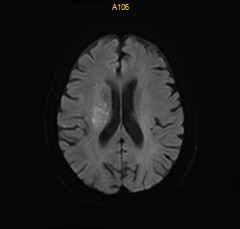 什么叫桡鞘【例久弥新】寻道于桡——瑞康通5.5F IntroSky X导管鞘经桡动脉行右侧大脑中动脉取栓一例_https://www.jmylbn.com_新闻资讯_第32张