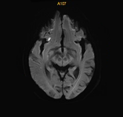 什么叫桡鞘【例久弥新】寻道于桡——瑞康通5.5F IntroSky X导管鞘经桡动脉行右侧大脑中动脉取栓一例_https://www.jmylbn.com_新闻资讯_第29张