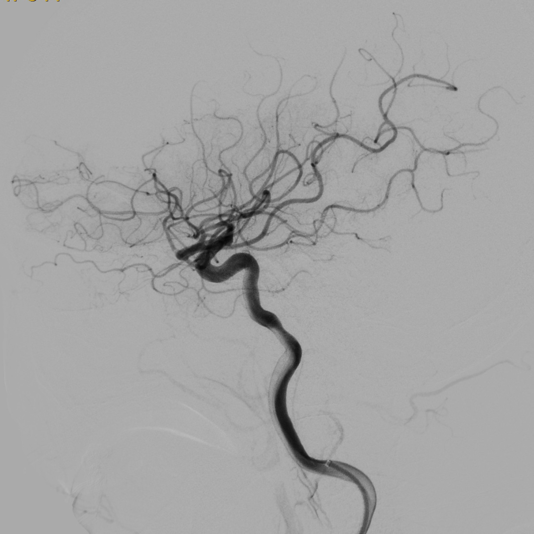 什么叫桡鞘【例久弥新】寻道于桡——瑞康通5.5F IntroSky X导管鞘经桡动脉行右侧大脑中动脉取栓一例_https://www.jmylbn.com_新闻资讯_第25张