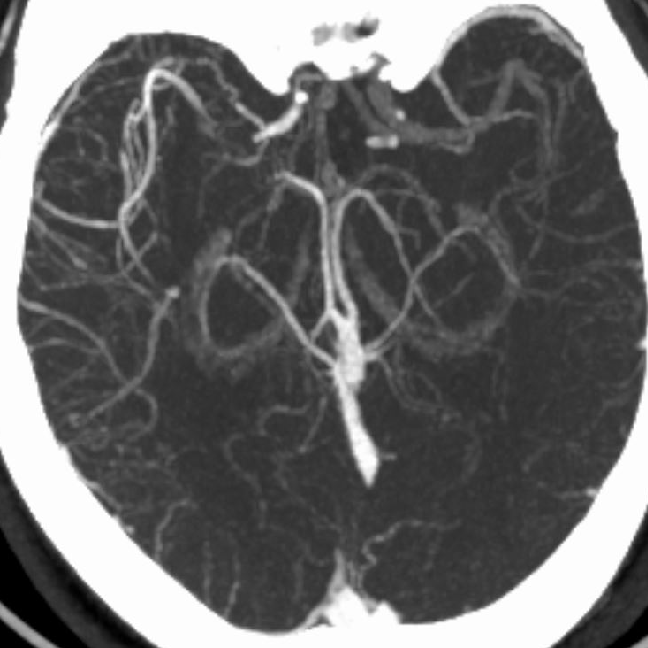 什么叫桡鞘【例久弥新】寻道于桡——瑞康通5.5F IntroSky X导管鞘经桡动脉行右侧大脑中动脉取栓一例_https://www.jmylbn.com_新闻资讯_第6张