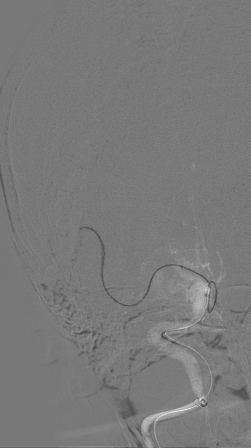 什么叫桡鞘【例久弥新】寻道于桡——瑞康通5.5F IntroSky X导管鞘经桡动脉行右侧大脑中动脉取栓一例_https://www.jmylbn.com_新闻资讯_第16张