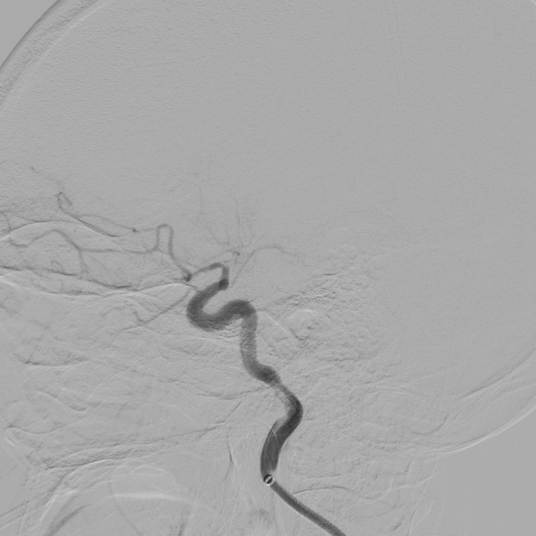 什么叫桡鞘【例久弥新】寻道于桡——瑞康通5.5F IntroSky X导管鞘经桡动脉行右侧大脑中动脉取栓一例_https://www.jmylbn.com_新闻资讯_第15张
