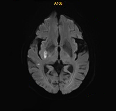 什么叫桡鞘【例久弥新】寻道于桡——瑞康通5.5F IntroSky X导管鞘经桡动脉行右侧大脑中动脉取栓一例_https://www.jmylbn.com_新闻资讯_第30张