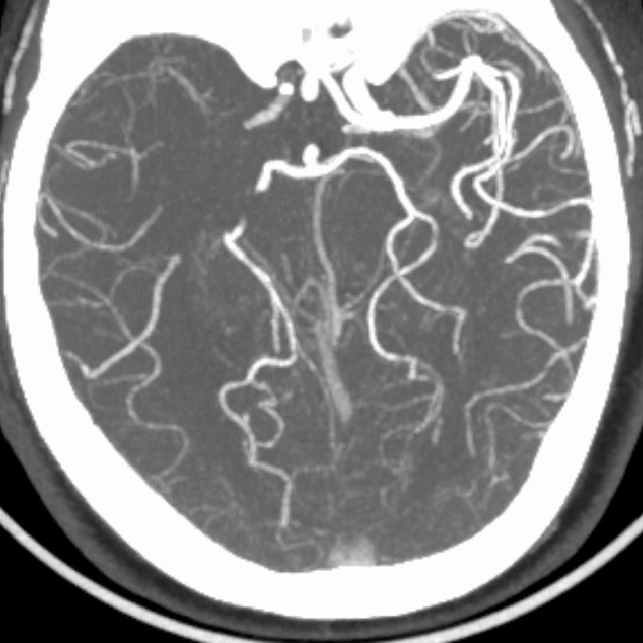 什么叫桡鞘【例久弥新】寻道于桡——瑞康通5.5F IntroSky X导管鞘经桡动脉行右侧大脑中动脉取栓一例_https://www.jmylbn.com_新闻资讯_第4张