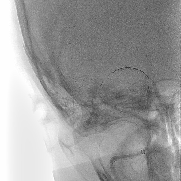 什么叫桡鞘【例久弥新】寻道于桡——瑞康通5.5F IntroSky X导管鞘经桡动脉行右侧大脑中动脉取栓一例_https://www.jmylbn.com_新闻资讯_第20张