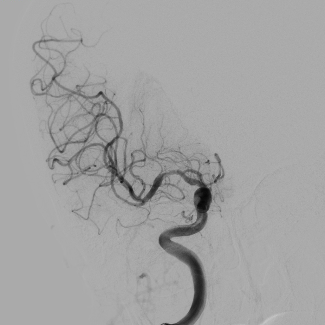 什么叫桡鞘【例久弥新】寻道于桡——瑞康通5.5F IntroSky X导管鞘经桡动脉行右侧大脑中动脉取栓一例_https://www.jmylbn.com_新闻资讯_第24张