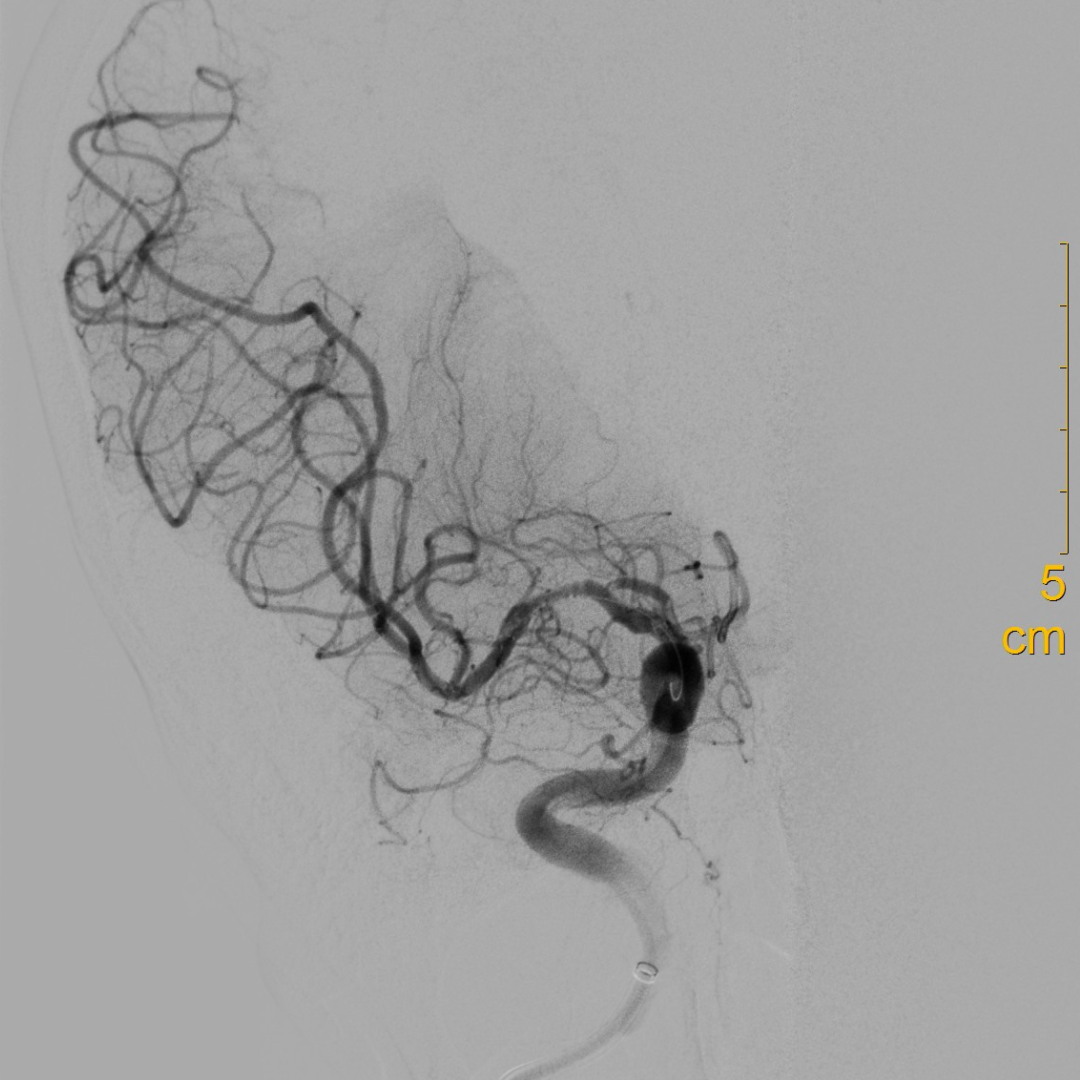 什么叫桡鞘【例久弥新】寻道于桡——瑞康通5.5F IntroSky X导管鞘经桡动脉行右侧大脑中动脉取栓一例_https://www.jmylbn.com_新闻资讯_第22张