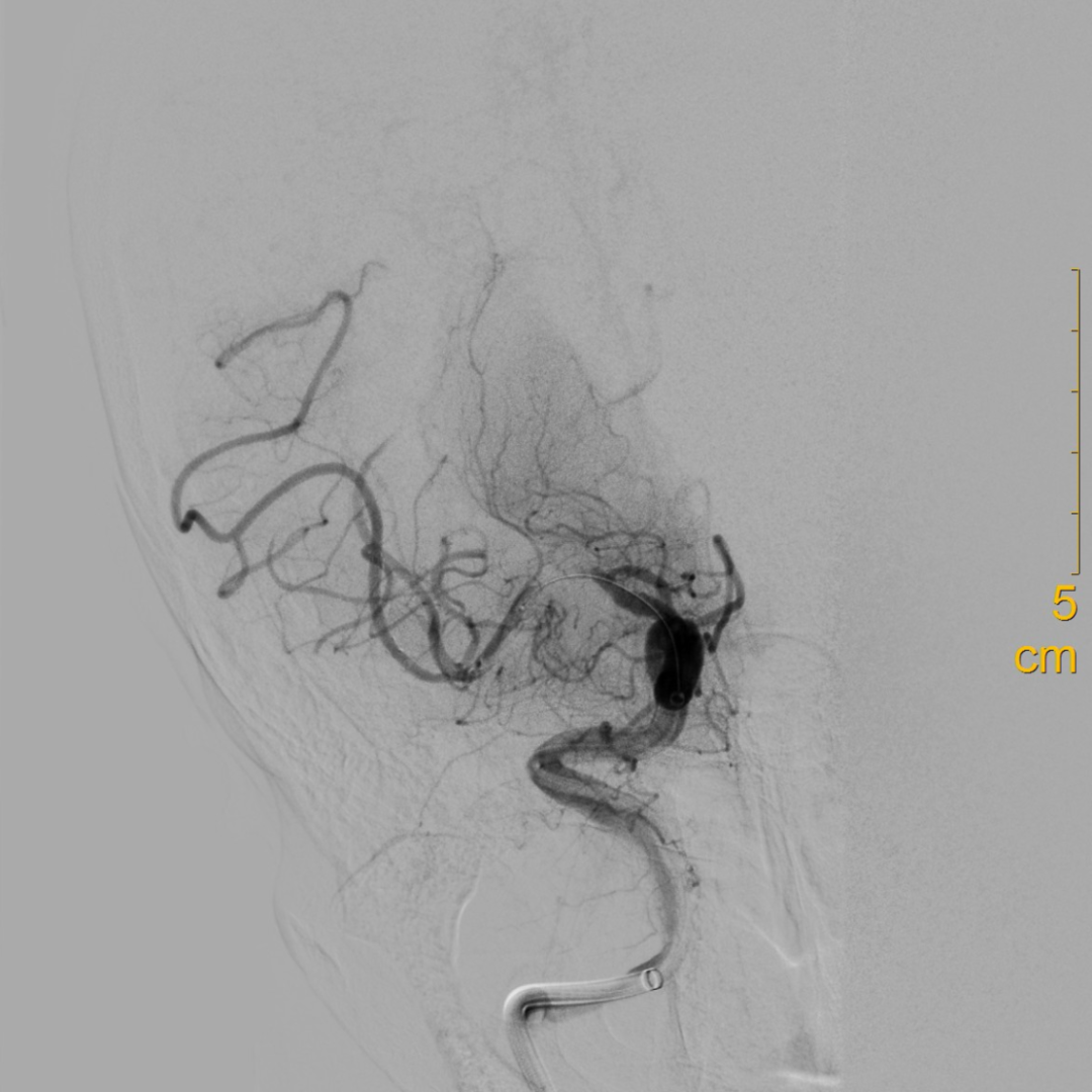 什么叫桡鞘【例久弥新】寻道于桡——瑞康通5.5F IntroSky X导管鞘经桡动脉行右侧大脑中动脉取栓一例_https://www.jmylbn.com_新闻资讯_第18张