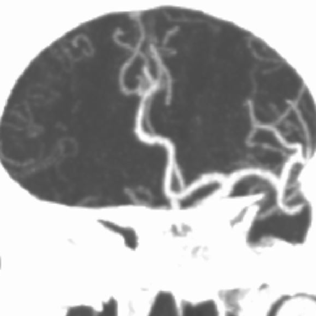 什么叫桡鞘【例久弥新】寻道于桡——瑞康通5.5F IntroSky X导管鞘经桡动脉行右侧大脑中动脉取栓一例_https://www.jmylbn.com_新闻资讯_第5张