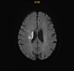 什么叫桡鞘【例久弥新】寻道于桡——瑞康通5.5F IntroSky X导管鞘经桡动脉行右侧大脑中动脉取栓一例_https://www.jmylbn.com_新闻资讯_第33张