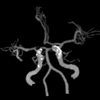 什么叫桡鞘【例久弥新】寻道于桡——瑞康通5.5F IntroSky X导管鞘经桡动脉行右侧大脑中动脉取栓一例_https://www.jmylbn.com_新闻资讯_第27张