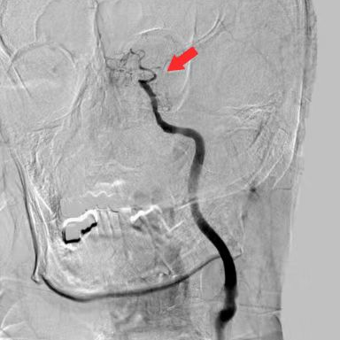 什么叫桡鞘【例久弥新】寻道于桡——瑞康通5.5F Introsky X导管鞘经桡取栓一例_https://www.jmylbn.com_新闻资讯_第11张