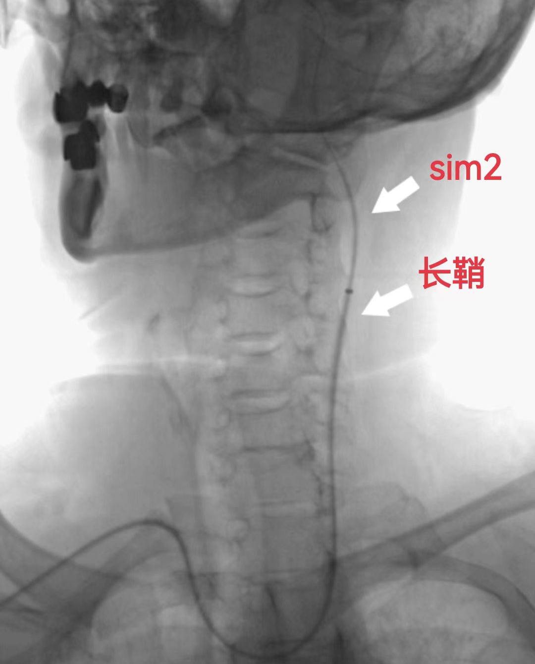 什么叫桡鞘【例久弥新】寻道于桡——瑞康通5.5F Introsky X导管鞘经桡取栓一例_https://www.jmylbn.com_新闻资讯_第15张