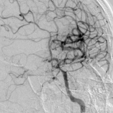 什么叫桡鞘【例久弥新】寻道于桡——瑞康通5.5F Introsky X导管鞘经桡取栓一例_https://www.jmylbn.com_新闻资讯_第25张