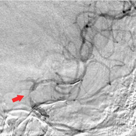 什么叫桡鞘【例久弥新】寻道于桡——瑞康通5.5F Introsky X导管鞘经桡取栓一例_https://www.jmylbn.com_新闻资讯_第21张
